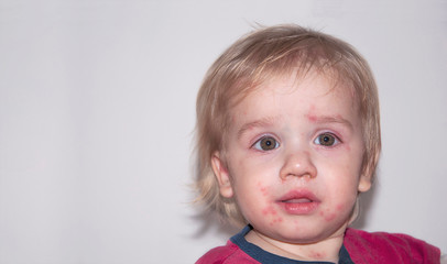 Chickenpox disease, with fever and runny nose. Boy sick on his back. Chickenpox virus, chicken pox...