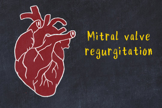 Concept Of Learning Cardiovascular System. Chalk Drawing Of Human Heart And Inscription Mitral Valve Regurgitation