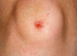 Fototapeta premium Wound on knee