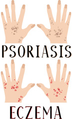 Psoriasis and eczema. Diseased skin. Sore hands. Medical poster. Dermatology and venereology.