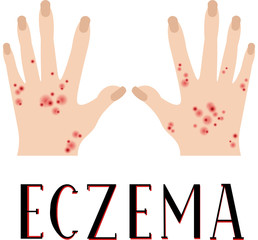Eczema. Diseased skin. Sore hands. Medical poster.