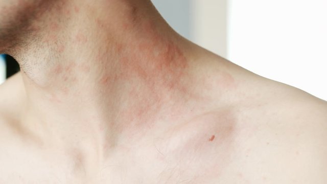 Man scratches a red rash on his neck in close-up. Allergies and skin diseases