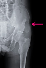 x-ray of a fracture of Ilium with displacement