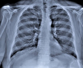 normal chest x-ray, diagnosis of pneumonia