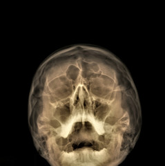 Fototapeta na wymiar x-ray of the paranasal sinuses of the facial skull
