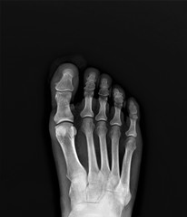normal x-ray of the foot bones