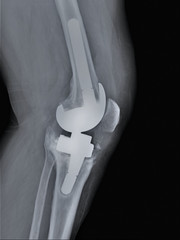 x-ray of the knee joint with a metal endoprosthesis