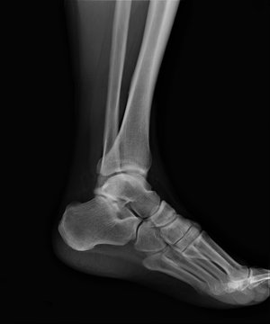 x-ray of the ankle joint, diagnosis of fractures