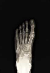 normal x-ray of the foot bones