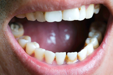 Tooth's a man smoking bad. Man smokes a cigarettes have tooth decay and calculus on teeth, So we should be care dental with the hygiene