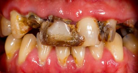 human teeth before dental treatment