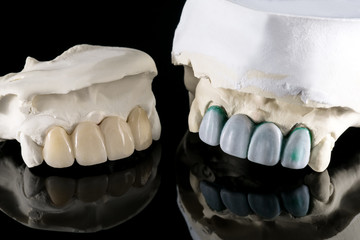 Closeup / Prosthodontics or Prosthetic / Tooth crown and bridge implant dentistry equipment and model express fix restoration.