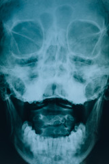X-ray of the head. Real x-ray picture of a skull. At the doctor’s appointment, hospital.