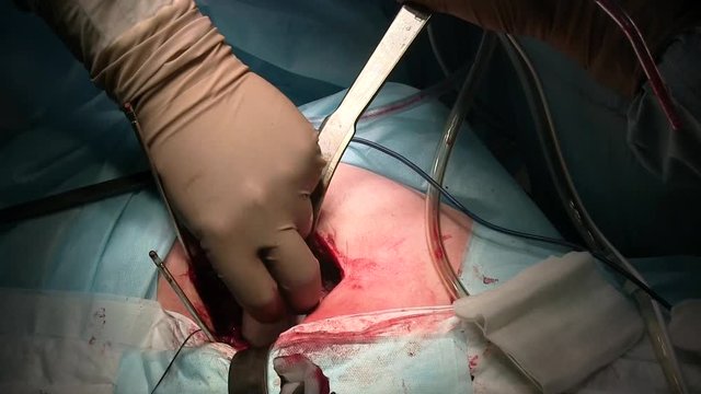 Surgeon puts special cement into the hip articular pit during the surgery
