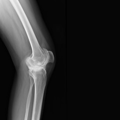 Real skeleton x-ray of woman knee suffering from rheumatism. Rheumatoid arthritis knee pain medical concept, medical diagnostics, traumatology and orthopedics