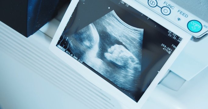 Tiny baby foot showing on the screen of the ultrasound machine. Close up