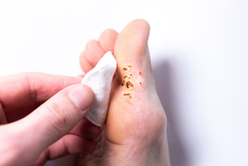 Marks from laser removal of wart. Contagious skin illness on foot. Man holding cotton pad on toe....