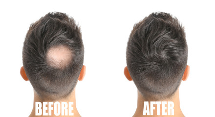 Man before and after hair loss treatment on white background