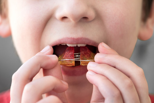 Close-up young boy applying retainer orthodontic appliance. Health care or dental hygiene concept. Soft focus
