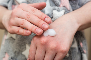 Woman put a soothing and moisturizing cream to dry, irritated skin of hands