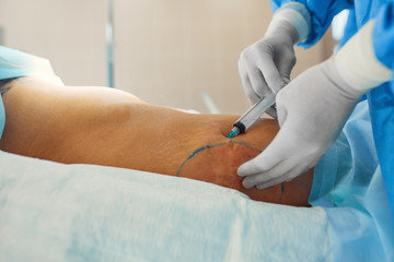 Liposuction corrective plastic surgery for liposuction of fat deposits in the abdomen. Beauty and success, crunchy body.