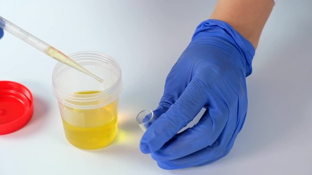 Doctor or laboratory technician dials urine from container with sample for analysis and research in medical laboratory, medical urine test and health scanning