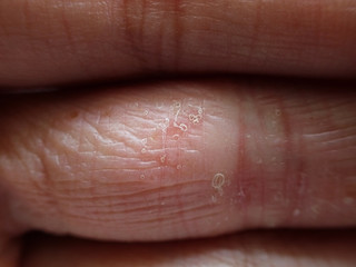 Dyshidrotic Eczema on finger close up
