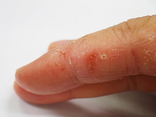 Dyshidrotic Eczema on finger close up