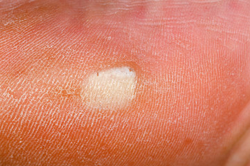 Fototapeta premium Blister on heel