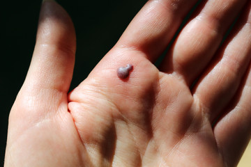 A blood blister on the palm of an open  hand