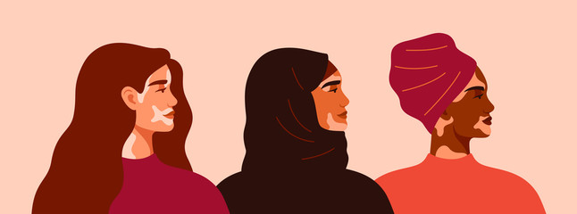 Three women with vitiligo of different nationalities standing together. Concept to support people living with vitiligo and to build awareness about chronic skin disorder.Vector illustration