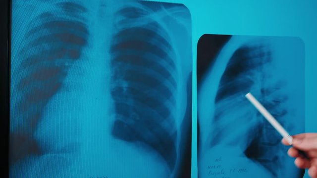 COVID-19. Pneumonia in the lungs in the image of a patient. Doctor of medicine. See Diagnostic Analysis. X-ray center.