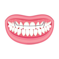 Braces on teeth. pink lips white teeth. White background. 
