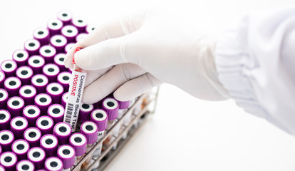 Doctor hand holding blood test for laboratory analysis.Laboratory testing patient’s blood samples.Conceptual image coronavirus (COVID-19) test tube sample that has tested positive for coronavirus.