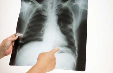 Woman doctor hands holding and point patient chest x-ray film .Image lung at radiology department...