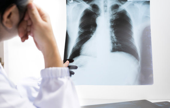Woman doctor looking patient chest x-ray film before treatment.Image lung at radiology department in hospital.Covid-19 scan body xray test detection for covid virus epidemic spread concept.