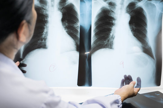 Woman doctor compare patient chest x-ray film before treatment.Image lung at radiology department in hospital.Covid-19 scan body xray test detection for covid virus epidemic spread concept.