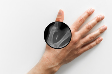 Hand with implantation of micro chip. X-Ray view close-up. Chipization of people, control...