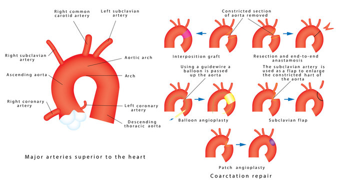 Coarctation repair. Coarctation of Aorta, congenital defect of the aorta (narrowing of the aortic arch). Major surgical aortic coarctation repair techniques.