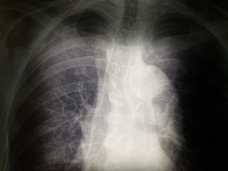 X-ray of the human chest