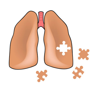 human lungs. lung diseases. vector illustration.