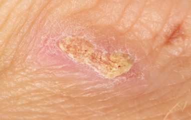 A wound from a knife cut on a person’s skin