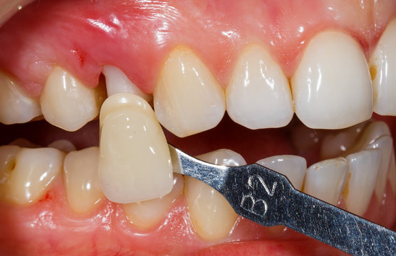 Teeth shade determination