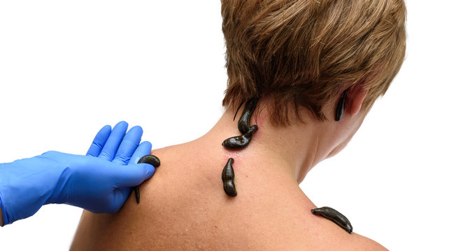 Blood sucking leechs hirudo medicinalis on woman's head and shoulders. Hand in blue glove holds a leech