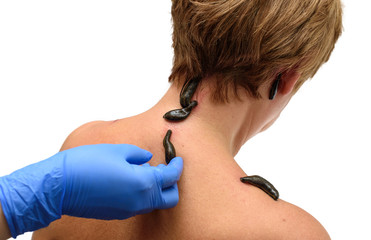 Blood sucking leechs hirudo medicinalis on woman's head and shoulders. Hand in blue glove holds a...