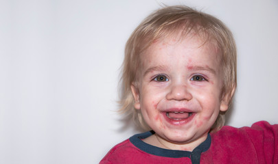 Chickenpox disease, with fever and runny nose. Boy sick on his back. Chickenpox virus, chicken pox...