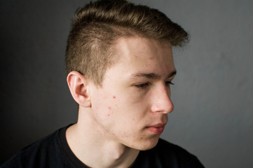 Obraz premium Young man struggling with acne on his face caring for his skin pushes acne