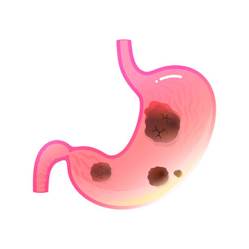 Vector isolated illustration of stomach cancer 