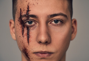 Teenage boy with wounds on face. Bullying and harassment.