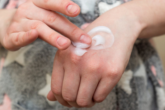 Girl Spreads A Soothing And Moisturizing Cream To Dry, Irritated Skin Of Hands